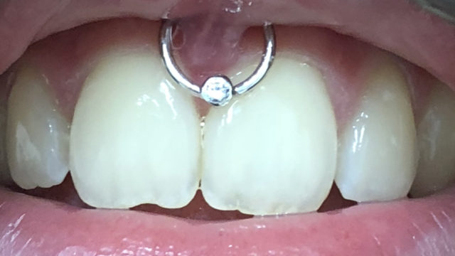 Smiley_Mariatashnijmegen_Diamond Segment Clicker